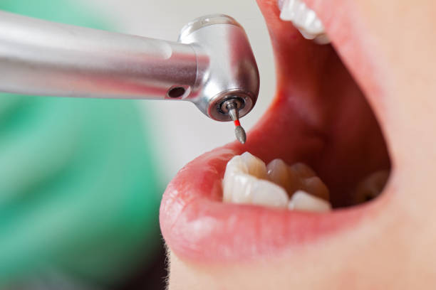 Best Broken or Cracked Tooth Emergency Dentist in Bonneauville, PA